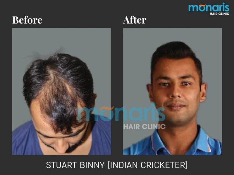 Stuart Binny: before-and-after hair transplant photographs