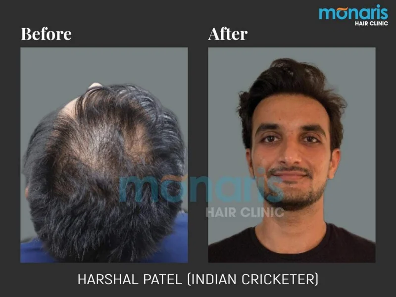 Harshal Patel: before-and-after hair transplant photographs