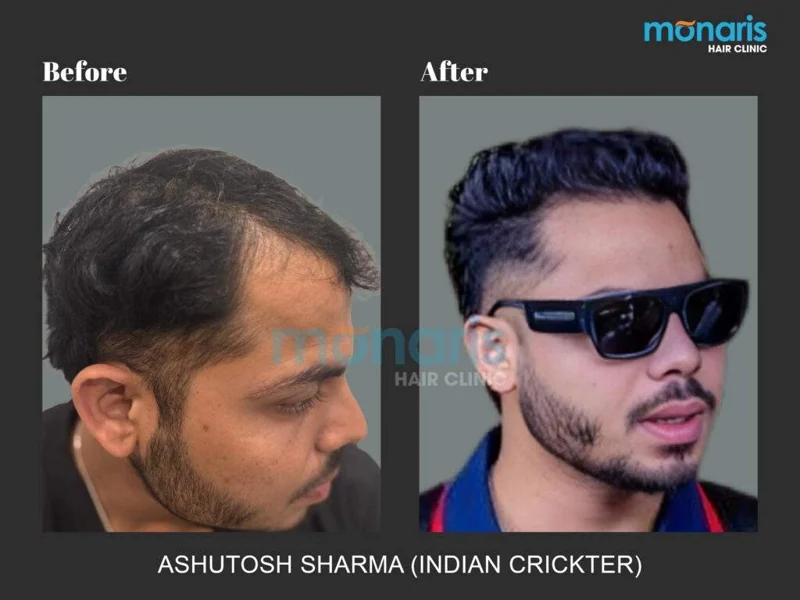 Ashutosh Sharma: before-and-after hair transplant photographs