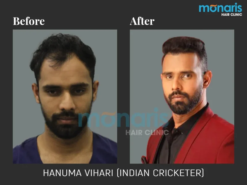 Hanuma Vihari: before-and-after hair transplant photographs