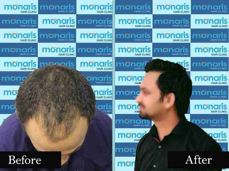 After Before 2 Hair Transplant Result by Dr.Arihant surana at Monaris Hair Clinic