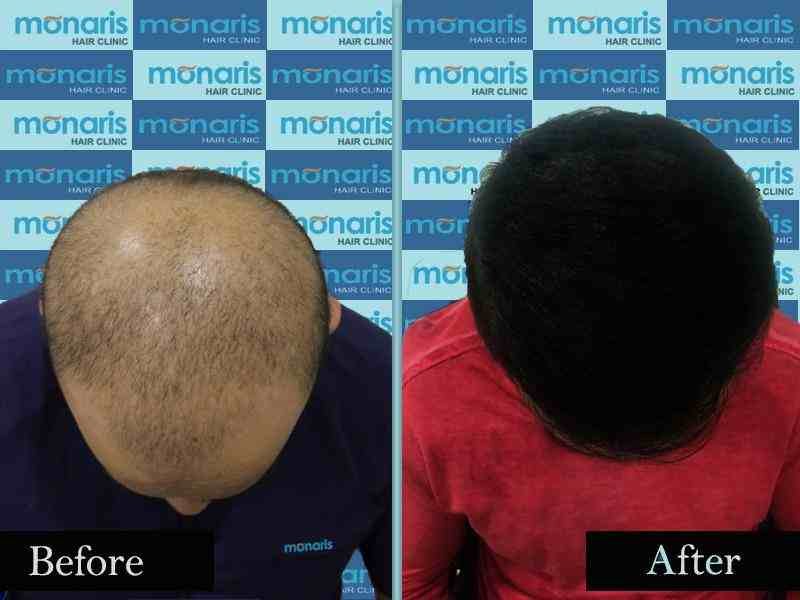 After Before 3 Hair Transplant Result by Dr.Arihant surana at Monaris Hair Clinic