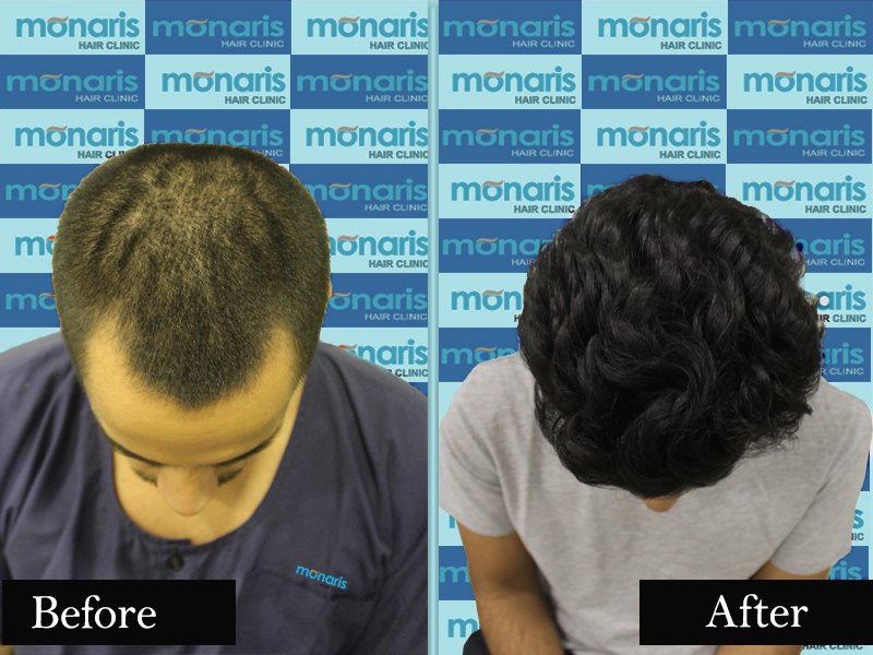 After Before 5 Hair Transplant Result by Dr.Arihant surana at Monaris Hair Clinic