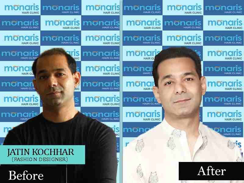 jatin kochhar Hair Transplant Result by Dr.Arihant surana at Monaris Hair Clinic