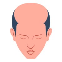 male-pattern-baldness