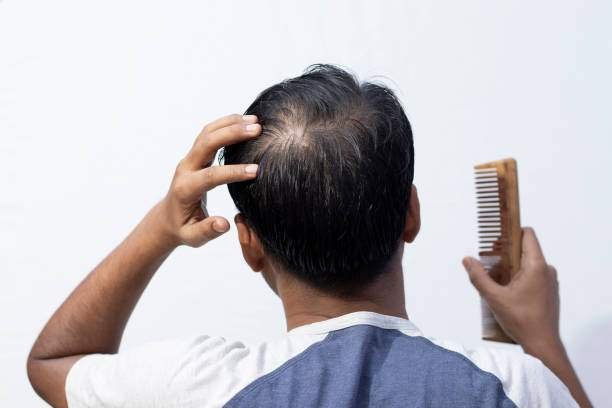 Hair Transplant Options in India