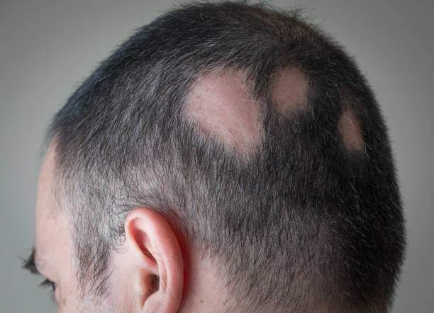 An example of patchy hair loss
