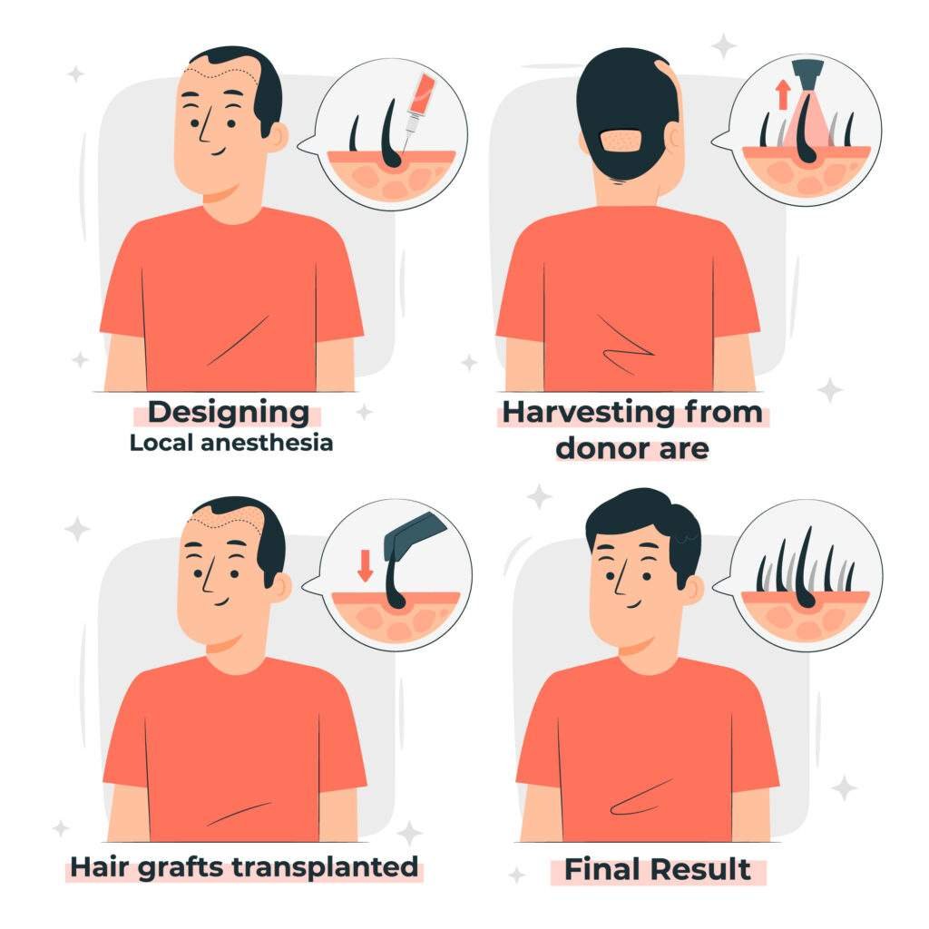 HAir tRansplant Monaris hair clinic 1