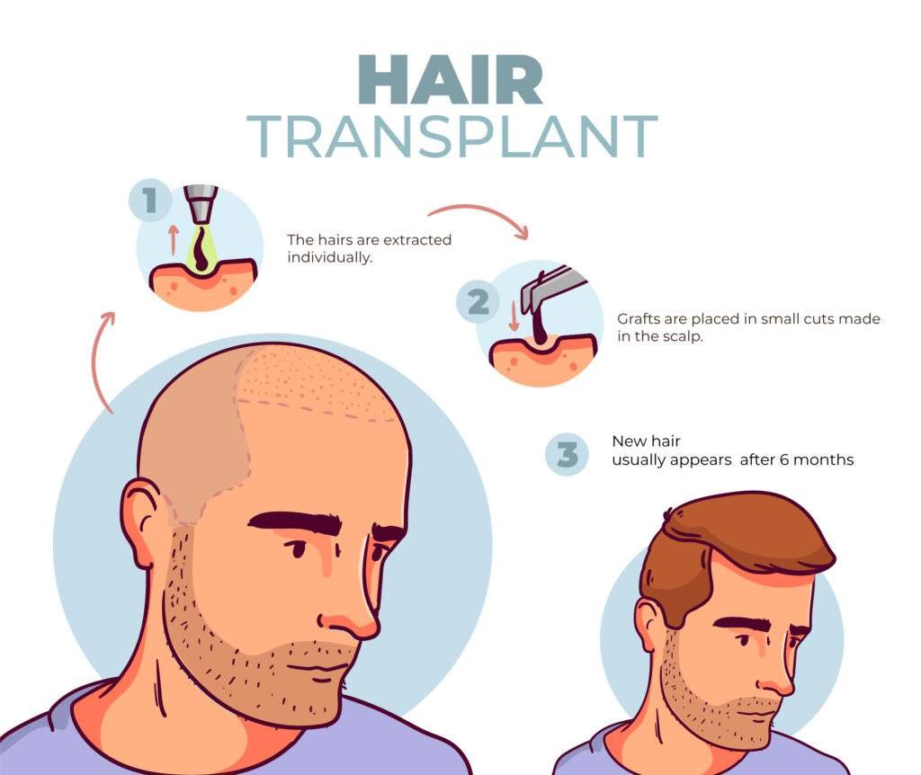 HAir tRansplant Monaris hair clinic 5