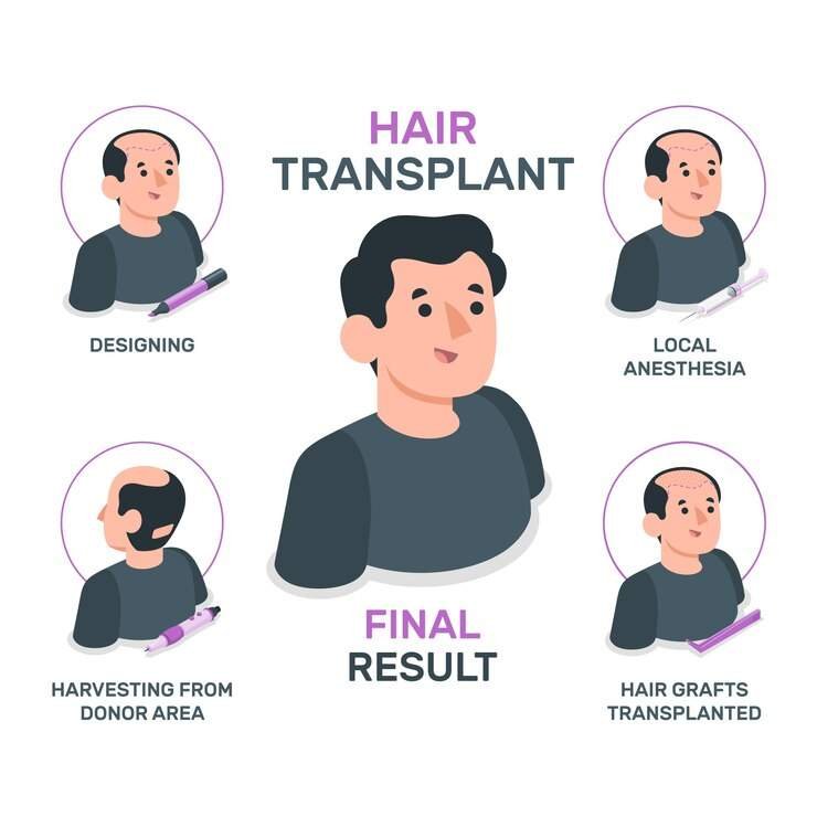 hair transplant 1