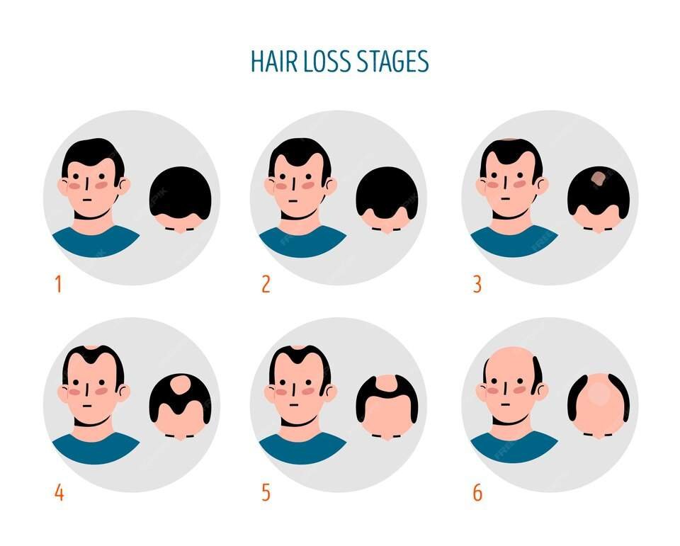 Male Pattern Baldness Clinic in india