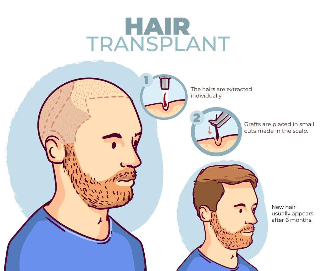 HAir tRansplant Monaris hair clinic 4