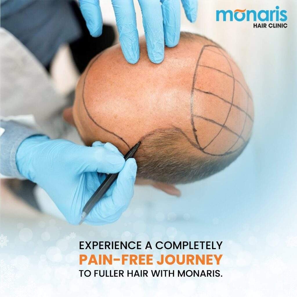 Pain free Hair transplant