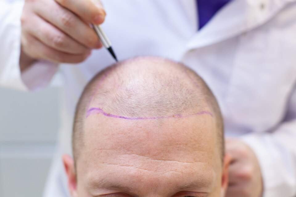 preparation hair transplant surgery