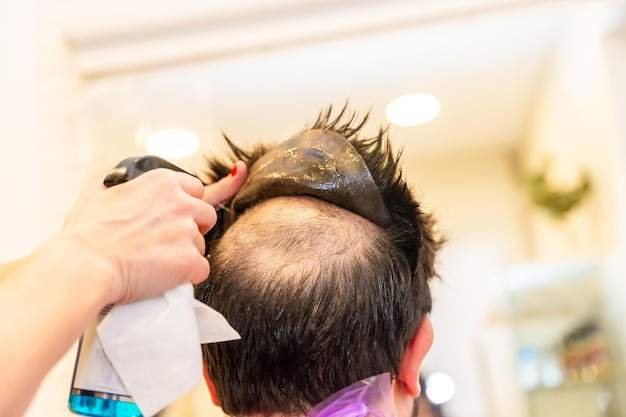 Say Goodbye to Hair Loss The Best Non Surgical Treatments That Work 1