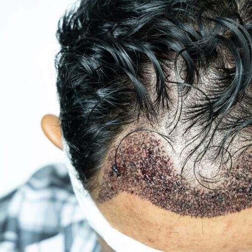 hair transplant scar myth