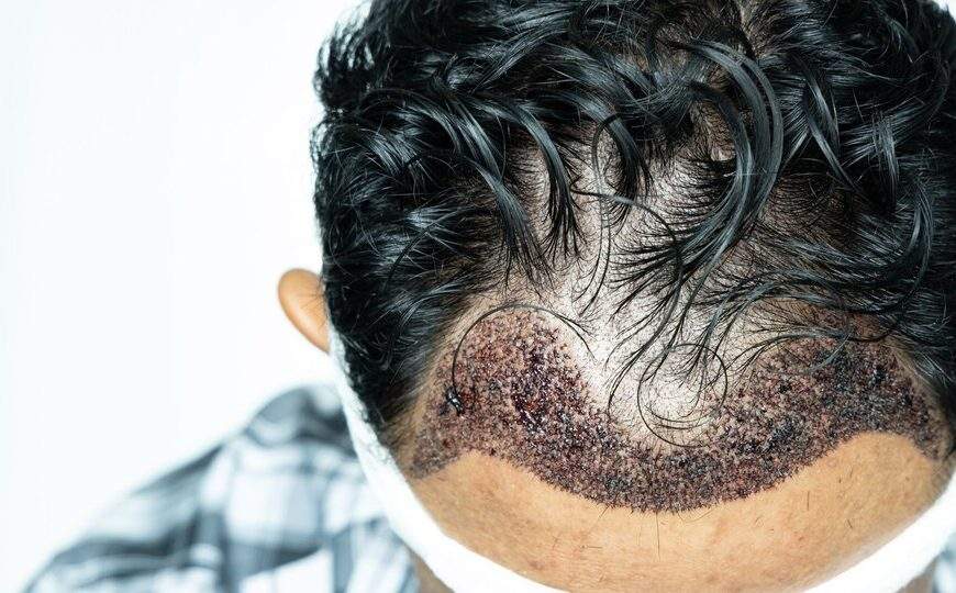 hair transplant scar myth