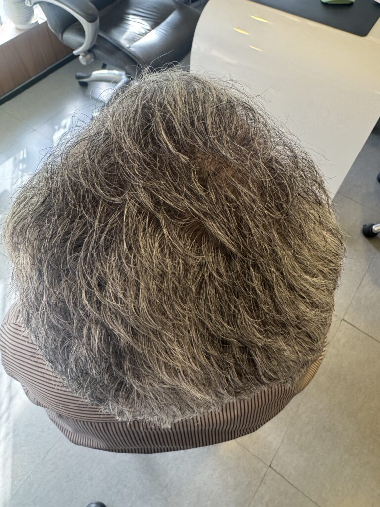 After hair transplant: overhead view — Monaris patient journey