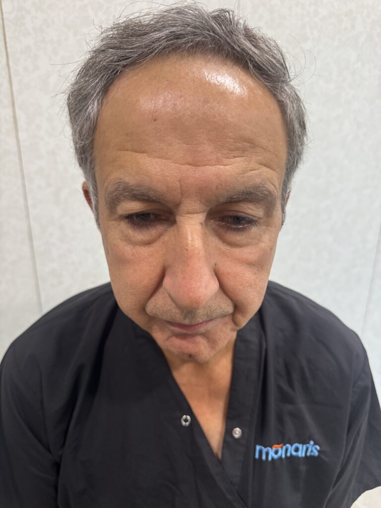 Before hair transplant: front view