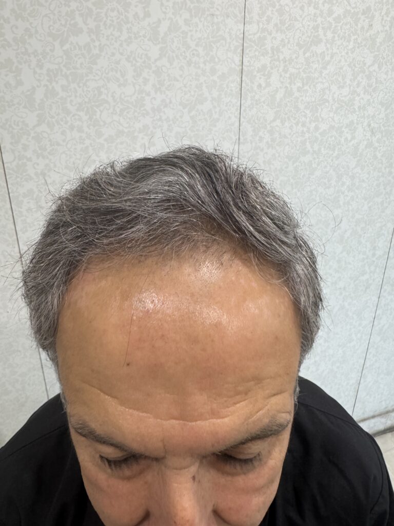 Before hair transplant: frontal top view — Monaris patient journey