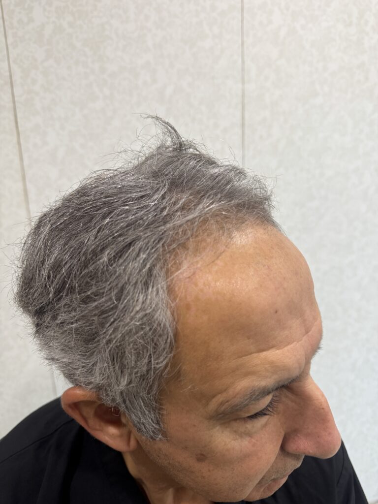 Before hair transplant: side view — Monaris patient journey
