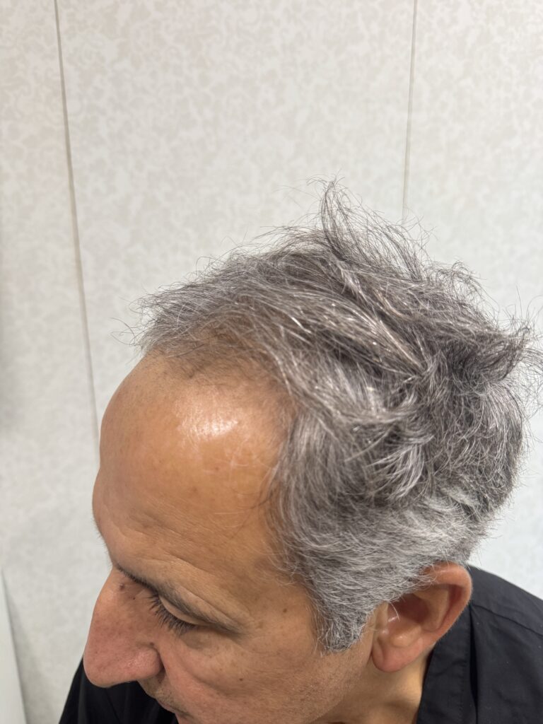 Before hair transplant: opposite side view — Monaris patient journey