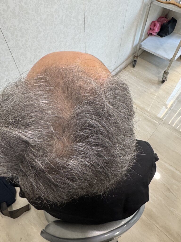 Before hair transplant: overhead view — Monaris patient journey