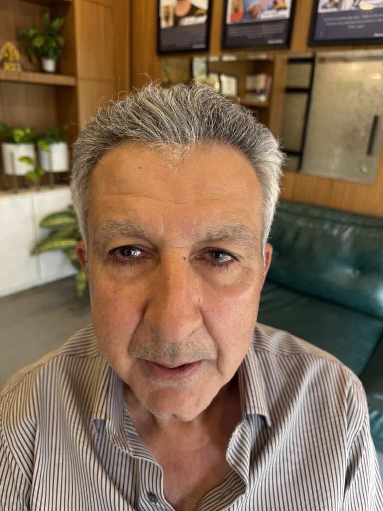 After hair transplant: front view