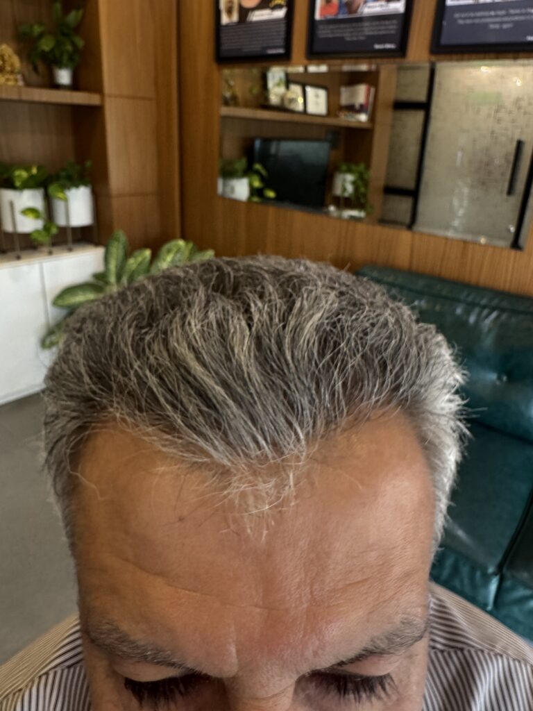 After hair transplant: frontal top view — Monaris patient journey