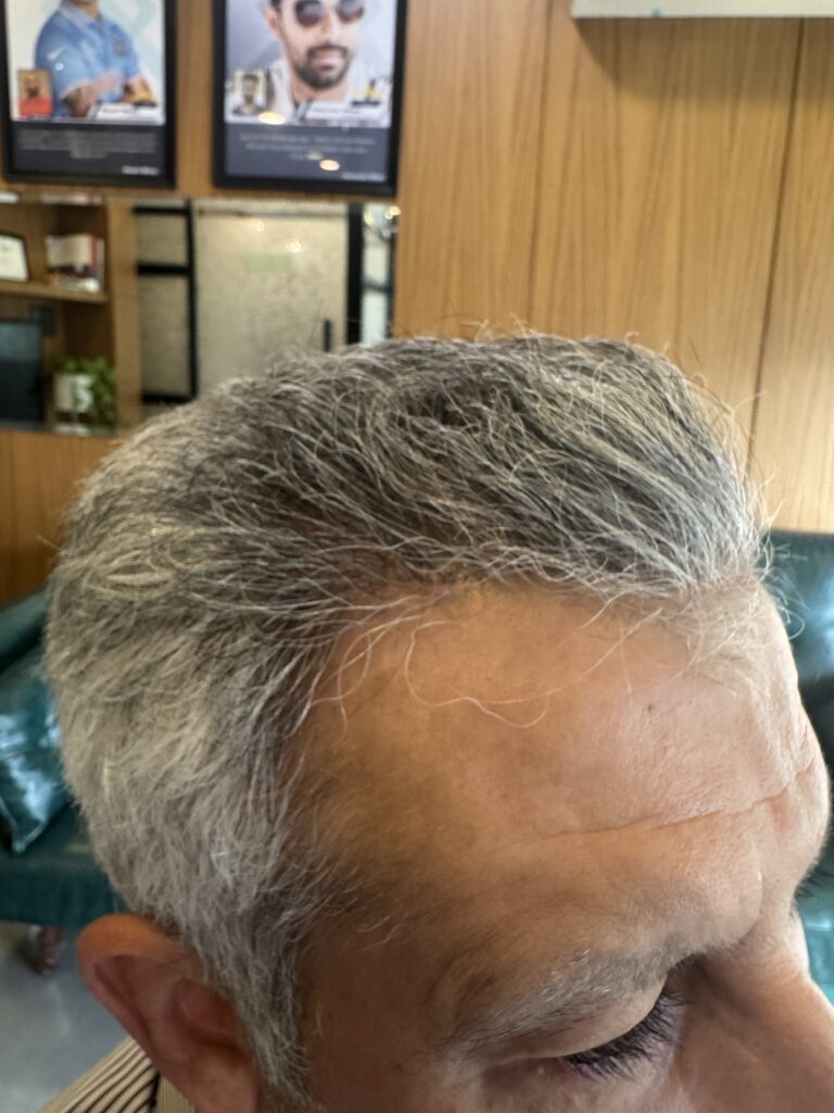 After hair transplant: side view — Monaris patient journey