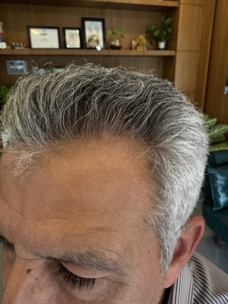After hair transplant: opposite side view — Monaris patient journey
